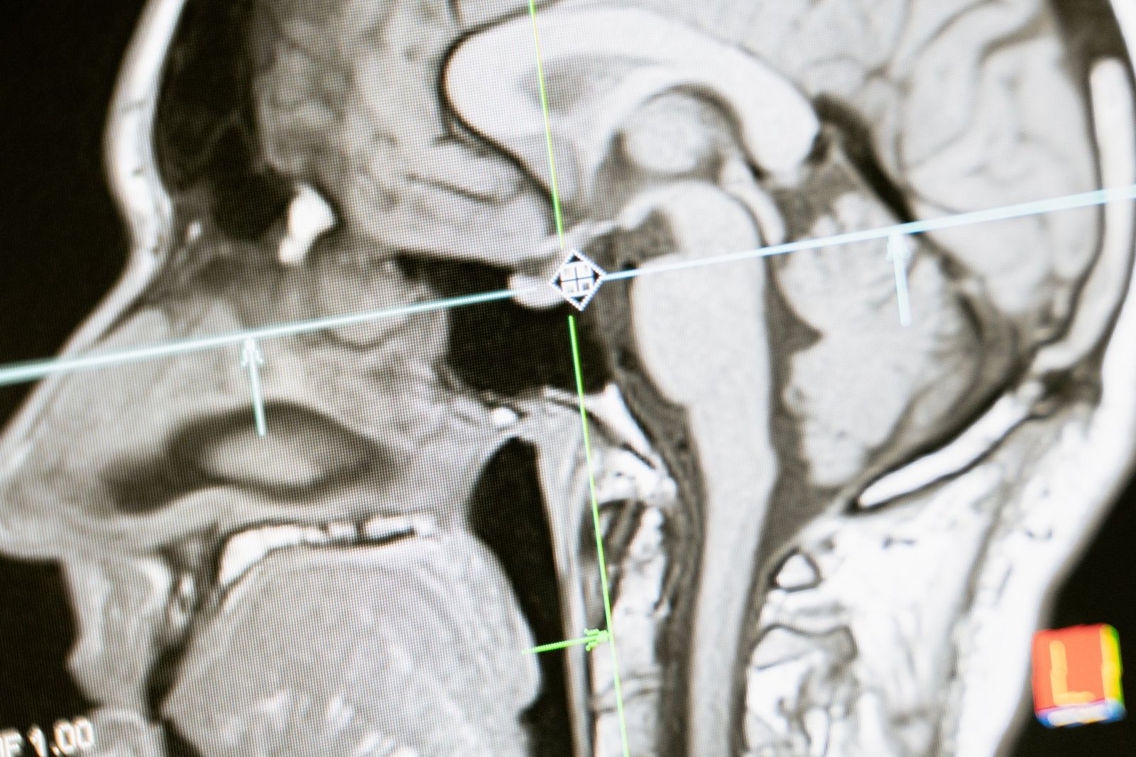 Study Reveals: Lab-grown mini brains may predict which Alzheimer’s treatments will work