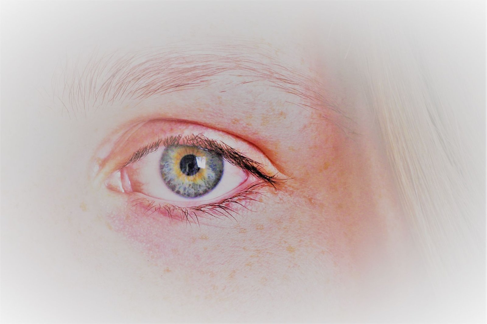 Lupus