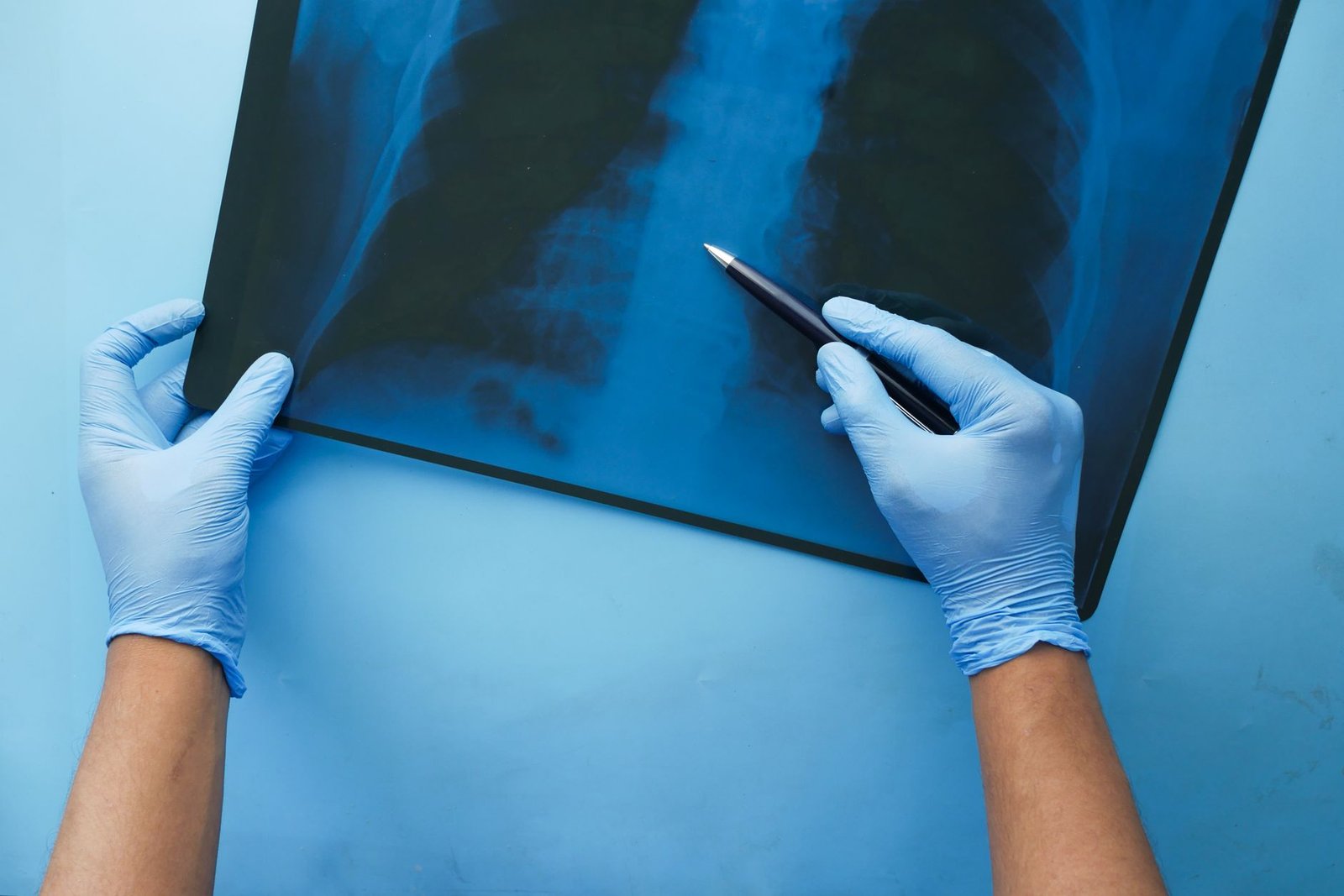 Pulmonary Fibrosis
