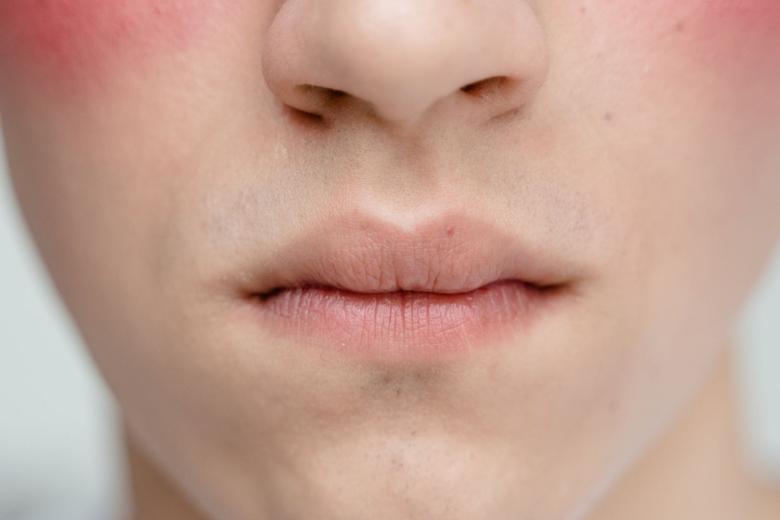 Rosacea